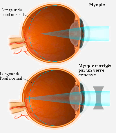 symptôme de myopie pentru refacerea temporară a vederii